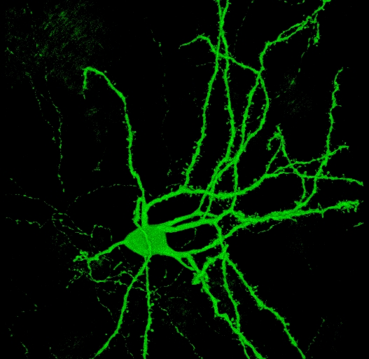 피부 세포를 뇌 세포로 바꾸기: 헌팅턴병 연구의 획기적인 발전일까?